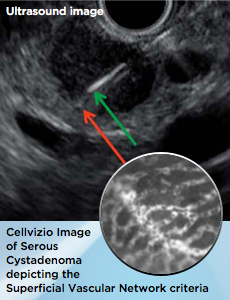 Cellvizio image of serous cystadenoma depicting the superficial vascular network criteria